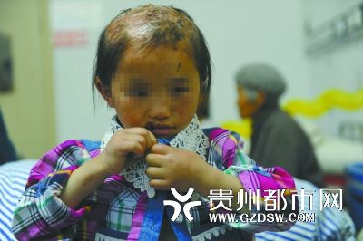 被燙傷的頭皮一直沒(méi)有愈合。