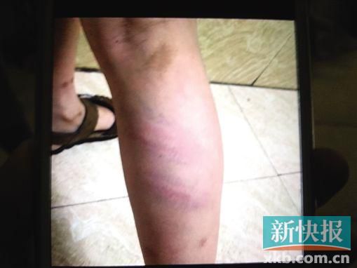 小宇腿部有明顯瘀痕。 翻拍自家屬手機(jī)