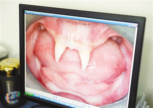 貴州:16歲男孩身患罕見基因病只長兩顆“獠牙” 貴州:16歲男孩身患罕見基因病只長兩顆“獠牙”