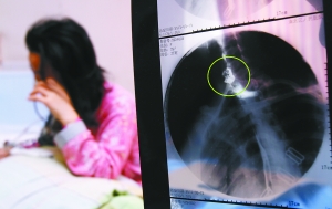 假牙上的鋼絲刺破食管，而薄薄的食道壁緊貼主動(dòng)脈血管，極易造成血管破裂