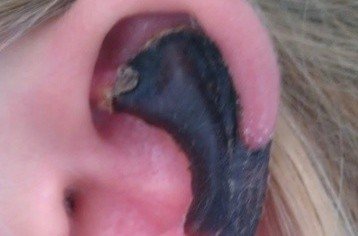 荷蘭女子旅游途中被蜘蛛咬，耳軟骨溶解變黑。