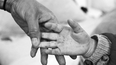 手足口病進(jìn)入高發(fā)季 河南省幼兒園開始每日晨檢 手足口病進(jìn)入高發(fā)季 河南省幼兒園開始每日晨檢