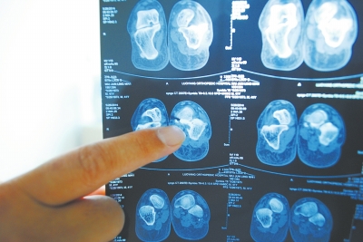 X光片顯示,確實有一根殘留的螺絲釘。