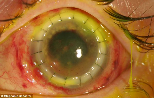 恐怖慎入！隱形眼鏡致英女子摘除眼球