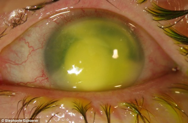 恐怖慎入！隱形眼鏡致英女子摘除眼球