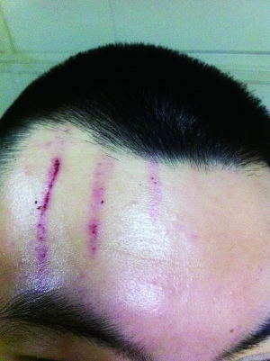 　2013年，被打者受傷照