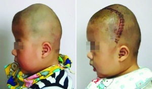 術前（左），術后（右）