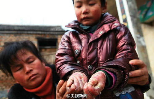 男孩皮膚一碰就破 裹衛(wèi)生紙堅(jiān)持上學(xué) 男孩皮膚一碰就破 裹衛(wèi)生紙堅(jiān)持上學(xué)