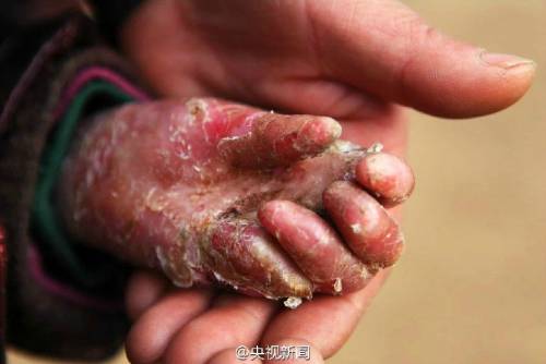 男孩皮膚一碰就破 裹衛(wèi)生紙堅(jiān)持上學(xué) 男孩皮膚一碰就破 裹衛(wèi)生紙堅(jiān)持上學(xué)