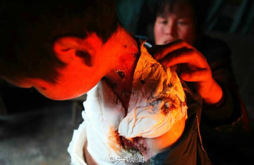 男孩皮膚一碰就破 裹衛(wèi)生紙堅(jiān)持上學(xué) 男孩皮膚一碰就破 裹衛(wèi)生紙堅(jiān)持上學(xué)