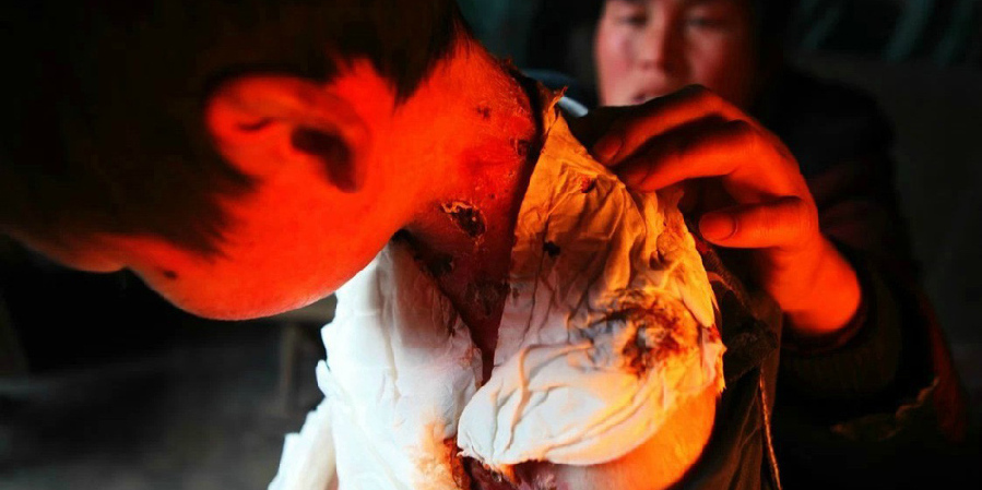 男孩皮膚一碰就破 裹衛(wèi)生紙堅(jiān)持上學(xué) 男孩皮膚一碰就破 裹衛(wèi)生紙堅(jiān)持上學(xué)