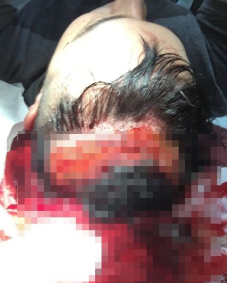 潘瑋柏傷口駭人 潘瑋柏傷口駭人