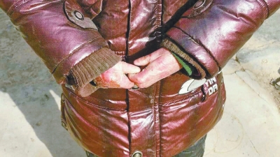 長期受損的手指，已經(jīng)長在了一起。