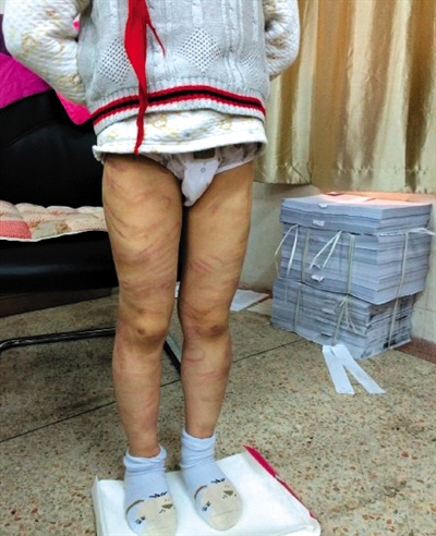 4月3日晚，微博網(wǎng)友“@朝廷半日閑”發(fā)圖文微博展示男童被虐待的慘狀。 微博截圖