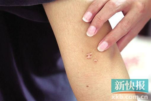 取出針后李星兒手臂留下了傷口。新快報記者 張國鋒/攝