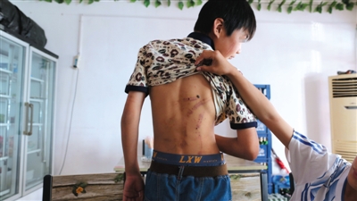 　昨日，奶西村，被打的小剛后背上條條瘀痕依然明顯。