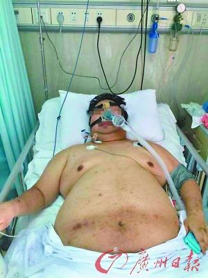 男子作息紊亂體重升至180公斤 搶救時(shí)壓塌2張病床