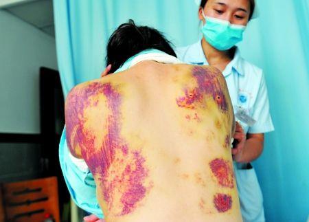 妻子被丈夫懷疑有外遇 懷孕7個(gè)月被打全身淤青 妻子被丈夫懷疑有外遇 懷孕7個(gè)月被打全身淤青