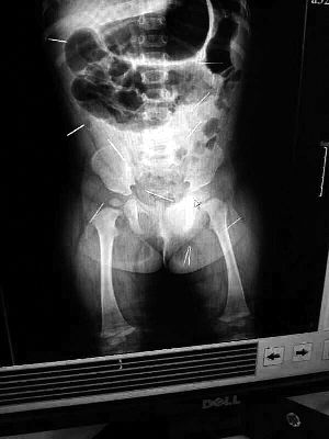 目前體內的12根鋼針多分布在孩子的臀部，一根在腹部，其余3根在胸腔附近，其中一根很接近心臟