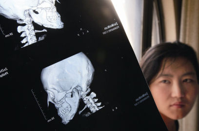 國內(nèi)醫(yī)院CT顯示，如今靳魏坤的鼻子假體是歪的，連下巴也是歪的