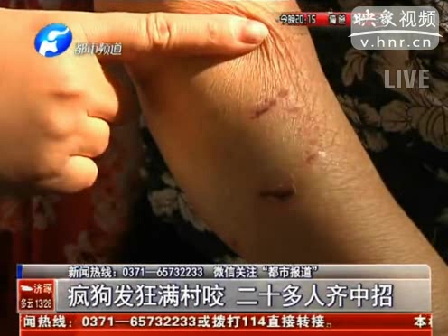 瘋狗發(fā)狂滿(mǎn)村咬人 20多人被咬