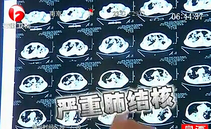 男子泡網(wǎng)吧七年導(dǎo)致嚴重肺結(jié)核