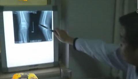 冷空氣來(lái)襲 如何預(yù)防老寒腿？